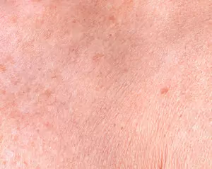 Hvordan behandler man brune pletter på huden?