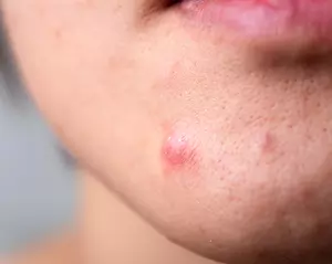 Sådan bekæmper du uren hud i ansigtet