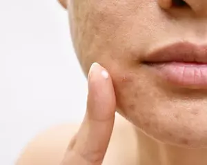 Akne - Årsager og behandling