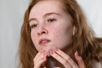 Uren hud i ansigtet - Hvad skal man gøre?