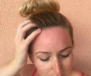 Er din hovedbund blevet forbrændt?