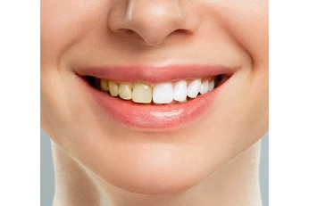 Drømmer du om hvide tænder?