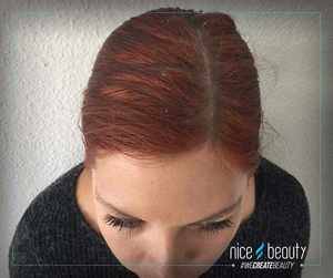 6 Tipps: So bekämpfst du Schuppen!