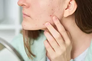 Hvordan fjerner man bumser?