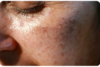 Sig farvel til pigmentpletter og ujævn hudtone