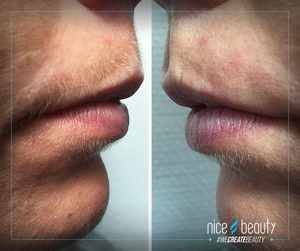 Og BUM - så er de uønskede hår væk!