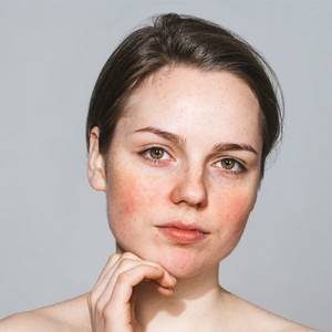 Hudpleje og makeup til rosacea & rødme