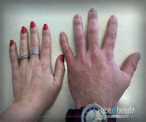 Rynker kvinders hud nemmere?