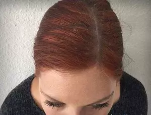 6 råd til at bekæmpe skæl